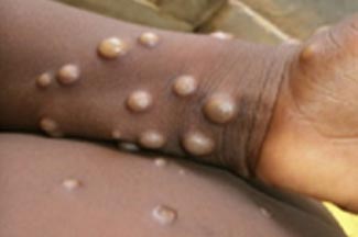 What is Monkeypox?